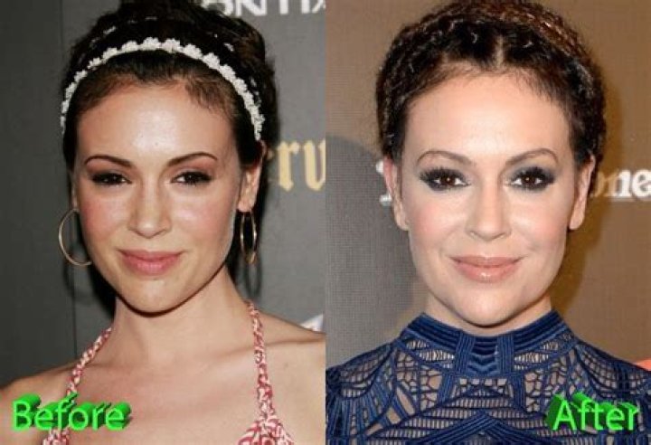 Alyssa Milano Plastic Surgery: Her Shocking Transformation