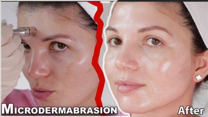 6 At-Home Microdermabrasion Kits That'll Make Skin Glow