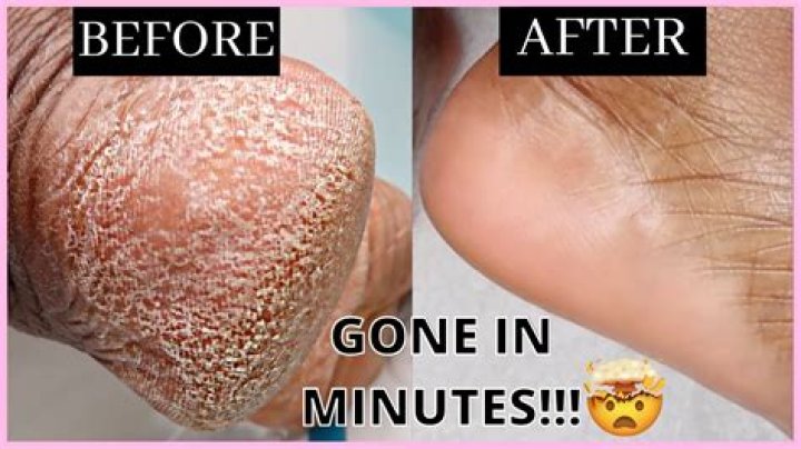 10 Ways to Dissolve (and Prevent) Dead Skin Buildup on Your Feet