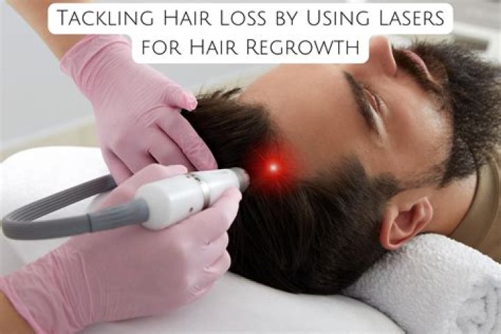 Lasers for Hair Regrowth: Experts Share Their Insights