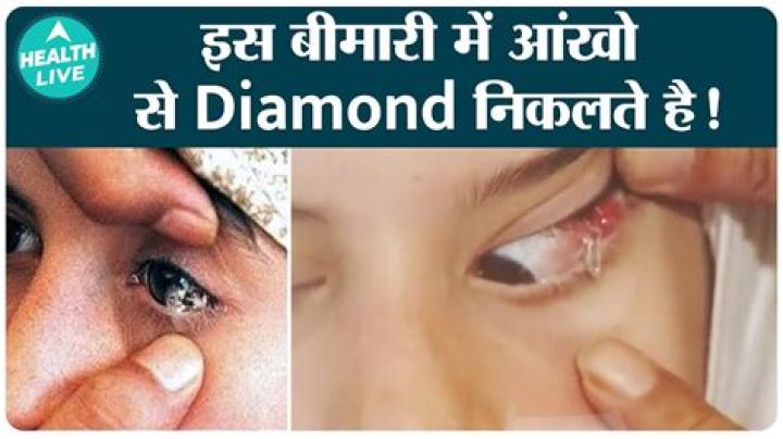 Medical Mystery Who 'Cries Crystal Tears' Believed To Be 'Faking' Condition