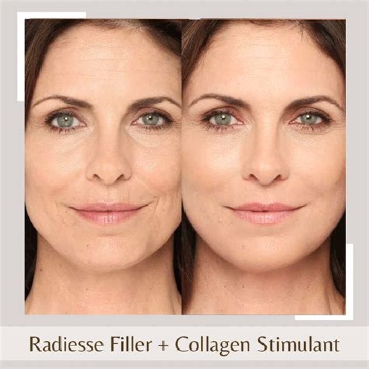 Everything to Know About Collagen-Boosting Fillers