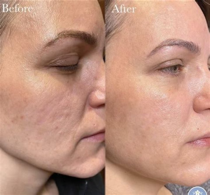 All About This Long-Term Skin Solution