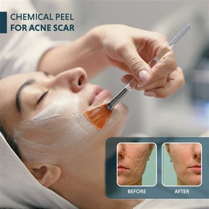 Safe Chemical Peels That Everyone Should Try