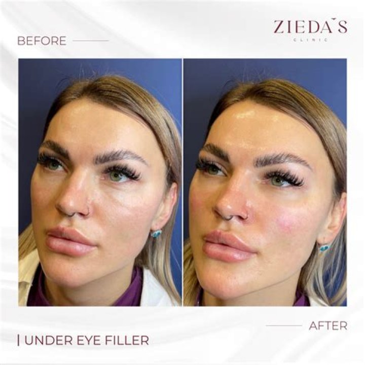 Under-Eye Filler Completely Changed My Face, Here's How