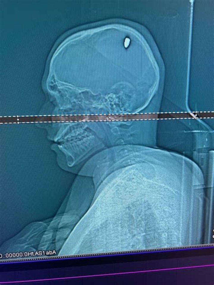 Doctor shows rare brain X-ray images showing impact of a gunshot wound to the head